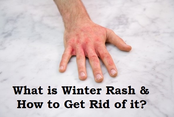 Winter Rash